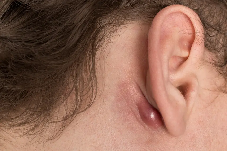 Swelling behind person's ear