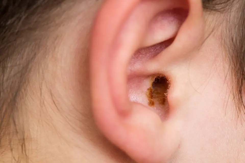 Wet Earwax in person's ear